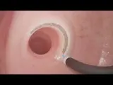 thumbnail photo of transoral outlet reduction endoscopy